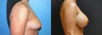 Large Breast Augmentation, 500cc Silicone Implants before 352767