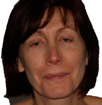 Facial Fat Injections before 296459