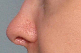 Juvederm in the nose before 343321