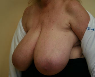 Breast Reduction before 485356