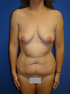 Abdominoplasty Liposuction/Breast Augmentation before 98751