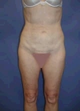 Liposuction after 139112