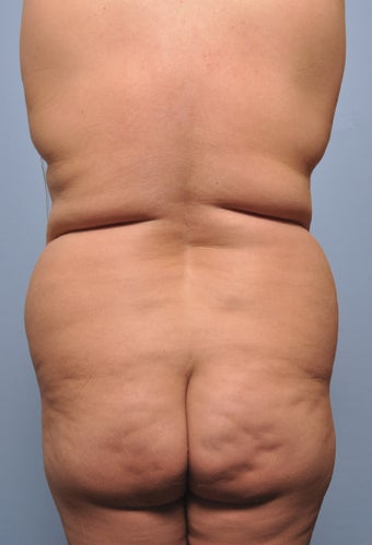 Body Liposuction before 520941