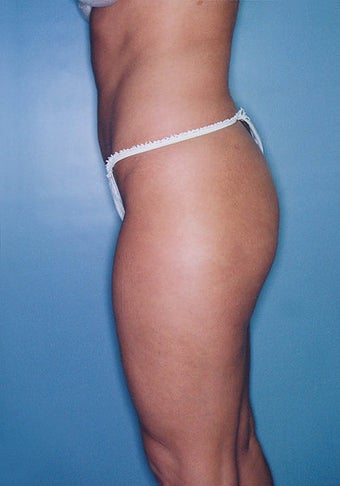 Power Assisted Liposuction (Hips, Thighs, Stomach & Back) after 276645