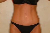 Full Lipoabdominoplasty after 133264