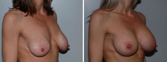 Breast implant revision after 332757