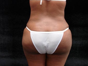 Brazilian Butt Lift after 183430