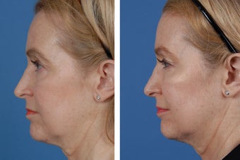 Restylane and Botox Cosmetic after 356495