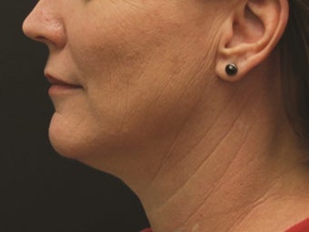 Neck Lift and Laser-Assised Lipocontouring after 406733