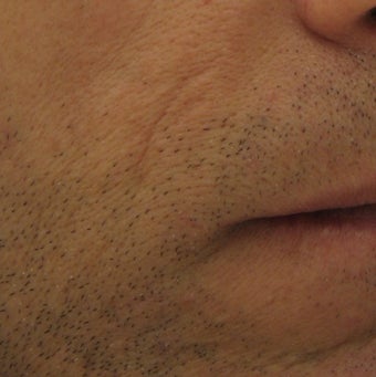 Belotero for fine etched-in lines in nasolabial folds 633104