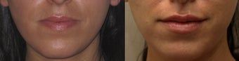 Lip Enhancement before 450121