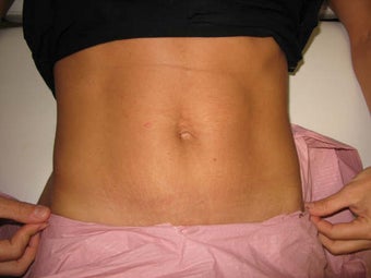 Laser Liposuction and Mini Tummy Tuck after 341296