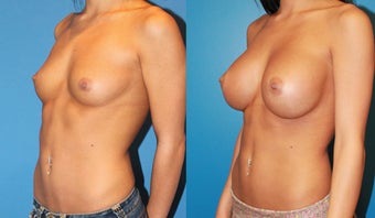 Breast Augmentation after 310714