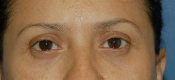 Upper and lower lid blepharoplasty and Fat Transfer to lower lids and midface after 307125