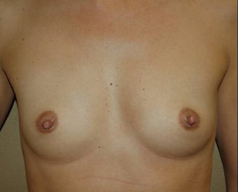 breast enlargement before 258901