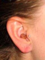 Earlobe Repair after 157517