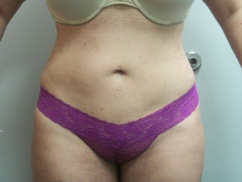 Liposuction after 258664