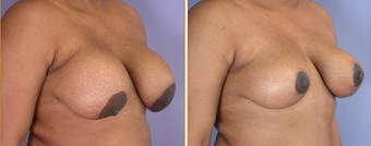 Breast Implant Removal before 270064