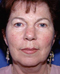 Facelift and Eyelid Surgery before 316338