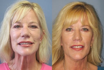 Lite Lift™, neck lift after 523722