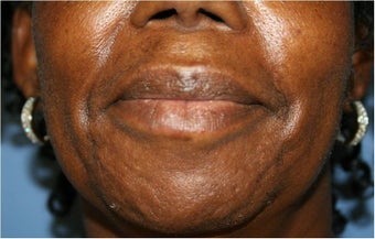 Lip augmentation with Juvederm after 302912