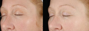 Ultherapy before 460621
