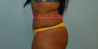 Abdominoplasty (Tummy Tuck) after 564440
