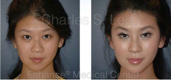 Blepharoplasty, Rhinoplasty and Chin Augmentation before 426944