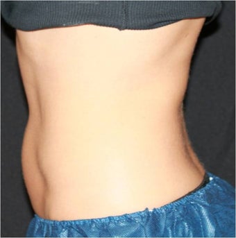 CoolSculpting 420663
