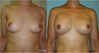Breast reconstruction following bilateral mastectomy before 416794