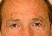 Before and After Blepharoplasty and Brow Lift after 87332