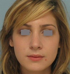 Rhinoplasty after 132705