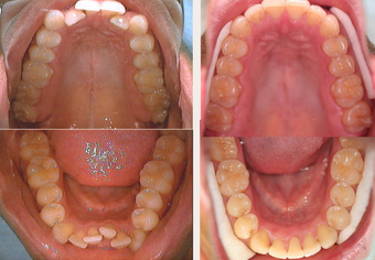 Invisalign before 145503
