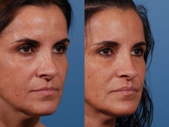 Revision rhinoplasty 435954