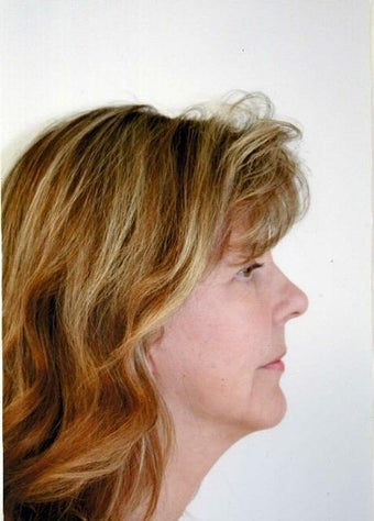 Neck Lift after 215152