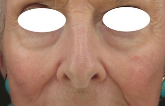 Midface, Cheeks, Tear troughs, and Nasolabial folds treated Restylane and Radiesse before 52828