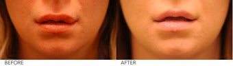 Lip Reduction after 245414