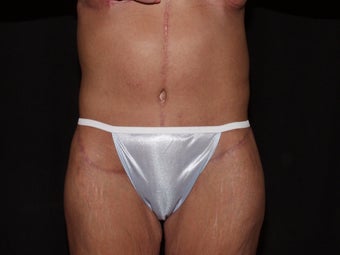 Body Lift after 479786