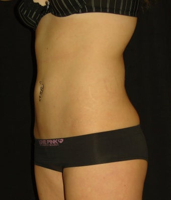 Lipoplasty after 132256