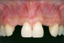 Congenital missing teeth and implants before 274782