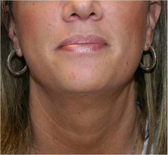 SmartLipo of Neck - Anterior View after 109276
