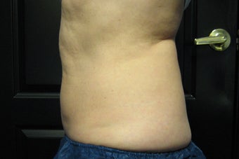 Zeltiq CoolSculpting after 300930