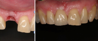 Dental Implant before 255698
