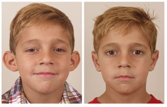 Otoplasty before 325133
