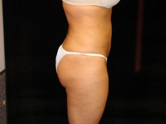 Liposuction of Abdomen, Waist, Flanks, and Inner/Outer Thighs after 203476