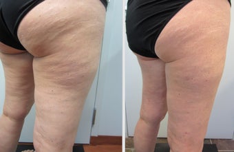 Cellulaze Laser Cellulite Reduction before 596657