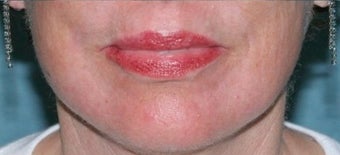 Fractional CO2 Laser Treatment after 374383