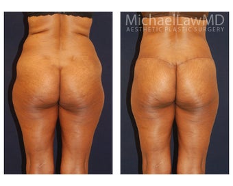 Lower Body Lift before 500848