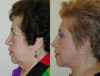 Composite Facelift, Upper and Lower Blepharoplasty after 142436