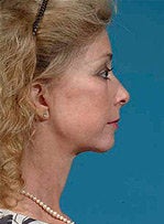 Face/neck/brow lift, upper/lower eyelid surgery 458800